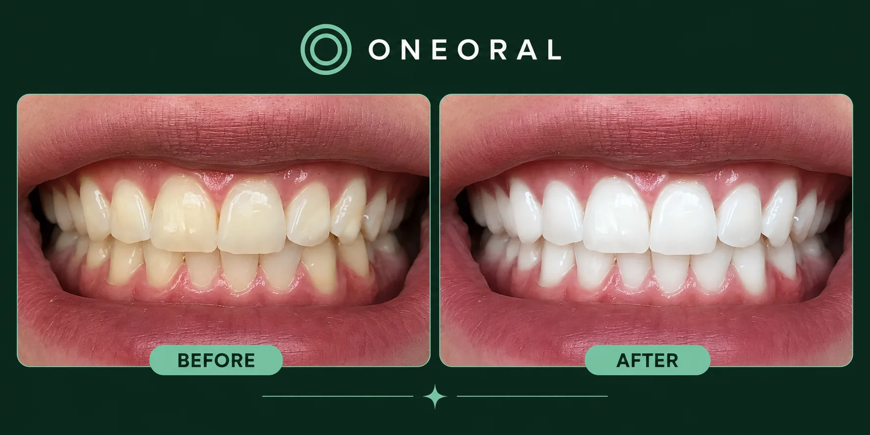 AI whitening before and after preview