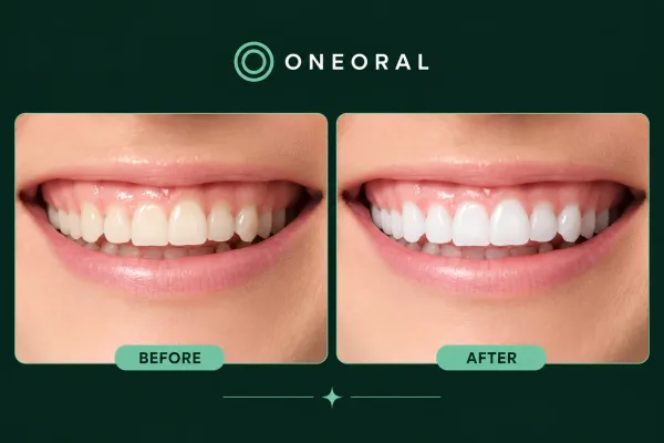 AI whitening before and after preview