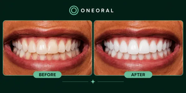 AI whitening before and after preview