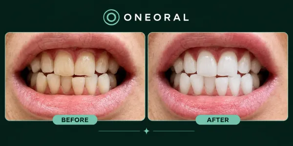 AI whitening before and after preview