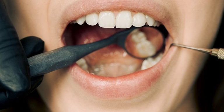 Dental Decay: Understanding Causes, Prevention, and Treatment